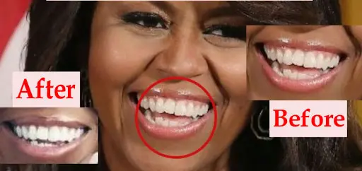 Michelle Obama’s Teeth Before and After